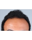 Before Hair Transplant &nbsp;Front